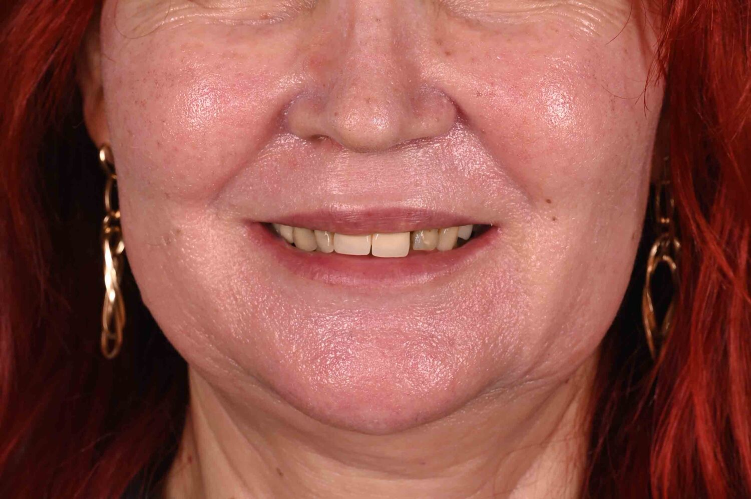 Pacient Clinica Dr. Alin Odor - Rezultat Implantologie